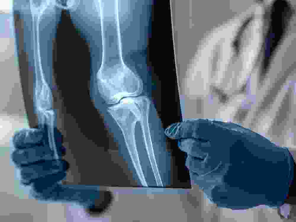 doctor checking fracture in knee bone on medical imaging film